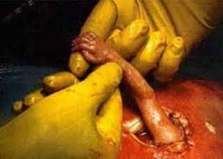 Em cirurgia inédita no Brasil, bebê baiano é operado ainda ligado à mãe