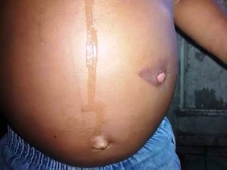 Aurelino Leal: Mãe é denunciada por queimar filho de 2 anos com ferro de passar roupas 