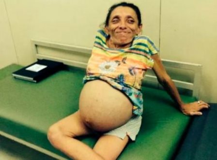 Natal: Anã de 1,2 metro de altura dá à luz a trigêmeas