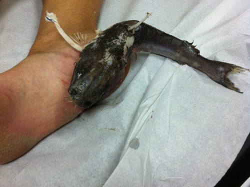 Santos-SP: Mulher fica com peixe preso no pé e passa por cirurgia para retirar animal