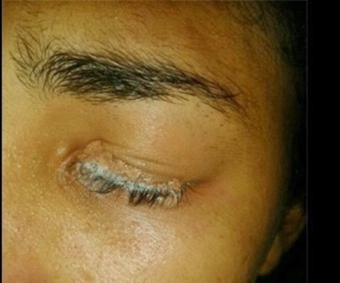 Mulher cola um dos olhos com super-bonder tentando pôr cílios postiços