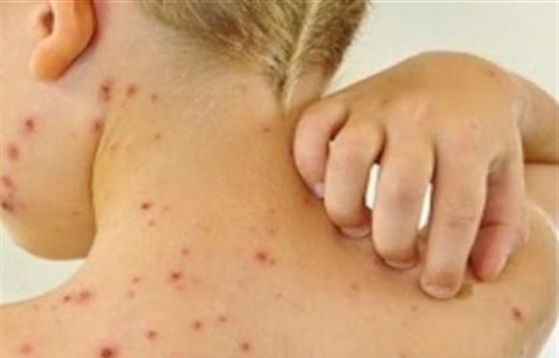 Governo libera R$ 3 milhões para combater surto de sarampo no Amazonas