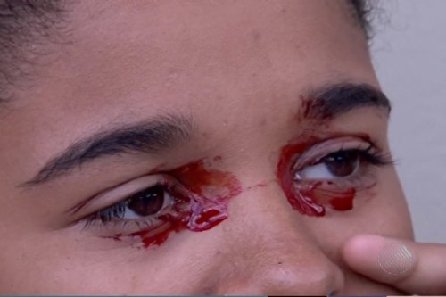 Adolescente de 14 anos sofre com saída de sangue pelos olhos, diz tia