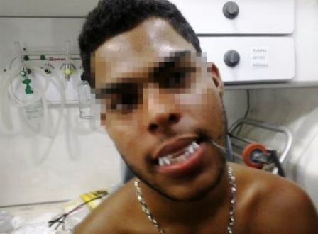 Ipiaú: Jovem costura dentadura de vampiro na boca e vai parar em hospital