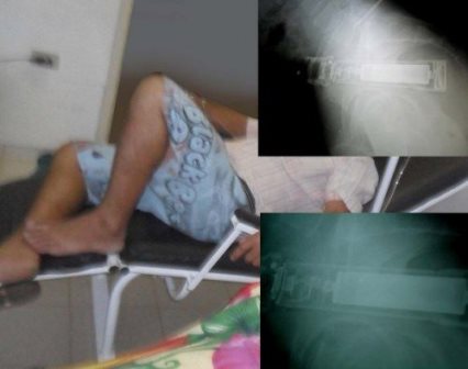 Acre: Caminhoneiro acorda com lanterna no ânus e alega ter sido dopado