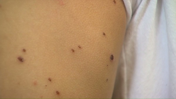 Município baiano suspende aulas após surto de catapora em alunos