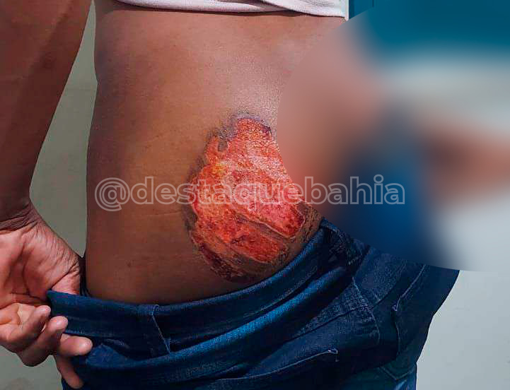 Crueldade e R@cismo: Polícia Civil prende patrões que usaram ferro em brasa para tortur@r funcionário em Livramento