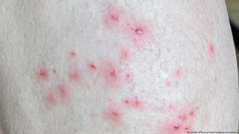 Bahia tem 119 casos confirmados de varíola dos macacos