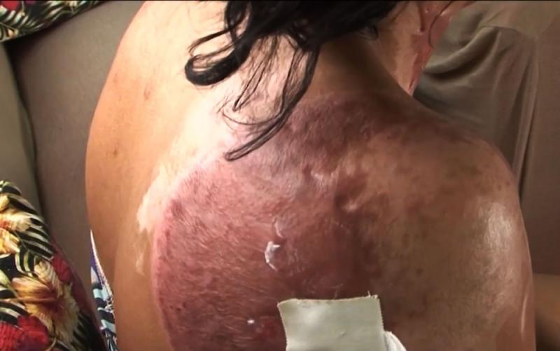 Mulher fica com parte das costas deformada após ex atear fogo nela na BA; homem está foragido há três meses