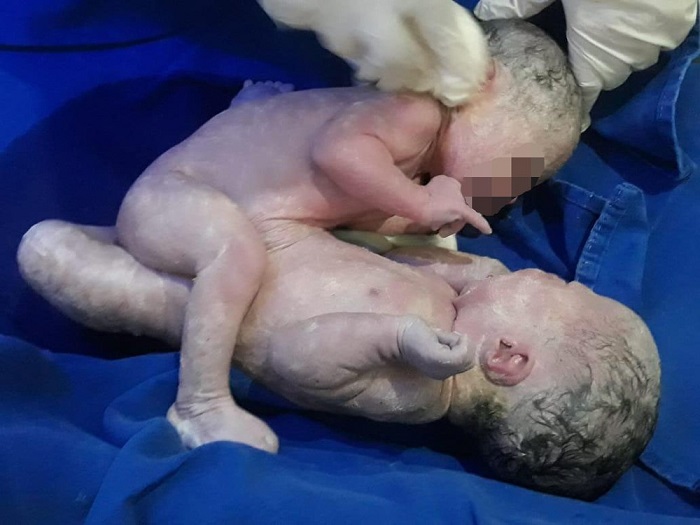 Bahia: Mãe de siamesas que nasceram ligadas pelo abdômen recebe alta