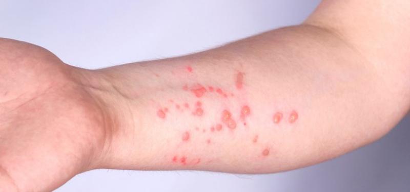 Brasil supera a marca de mil casos de Mpox em 2024