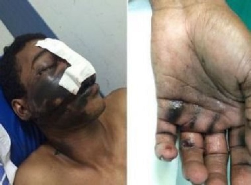 Homem fica ferido após explosão de celular durante ligação