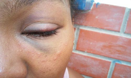 Mulher é espancada por marido viciado em Drogas, mas impediu que o mesmo ficasse preso