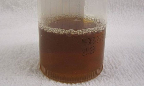 Doença da urina preta na Bahia: o que sabemos até agora