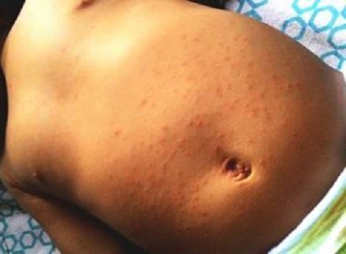 Bahia registra 64 casos confirmados de Guillain-Barré, aponta Sesab