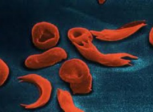 Recôncavo baiano: Profissionais serão capacitados para manejo de doença falciforme